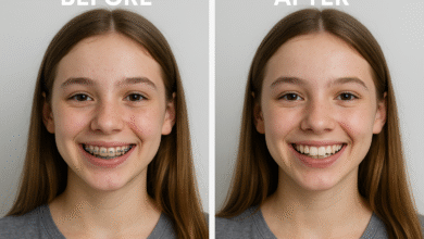 Braces Before and After