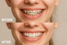 braces before after