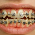 Braces on Crooked Teeth