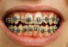 Braces on Crooked Teeth