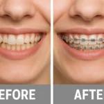 Dental Braces Before and After