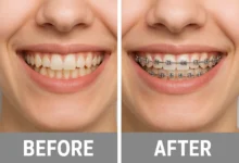 Dental Braces Before and After