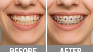 Dental Braces Before and After