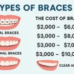 How Much Do Braces Cost