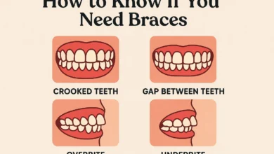 How to Know If You Need Braces