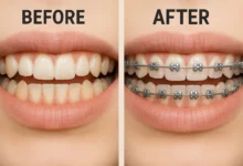 Orthodontic Braces Before and After