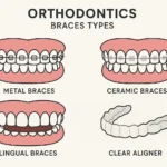 Orthodontics Braces Types