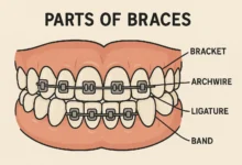 Parts of Braces