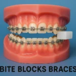 bite blocks braces