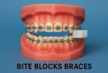 bite blocks braces