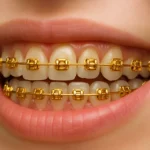 gold metal braces