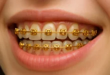 gold metal braces