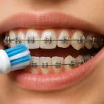 Best Toothbrush Braces Cleaning helps keep teeth and gums healthy during orthodontic treatment.