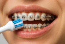 Best Toothbrush Braces Cleaning helps keep teeth and gums healthy during orthodontic treatment.