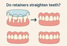 Explore how retainers work to straighten teeth and their role in maintaining orthodontic results.