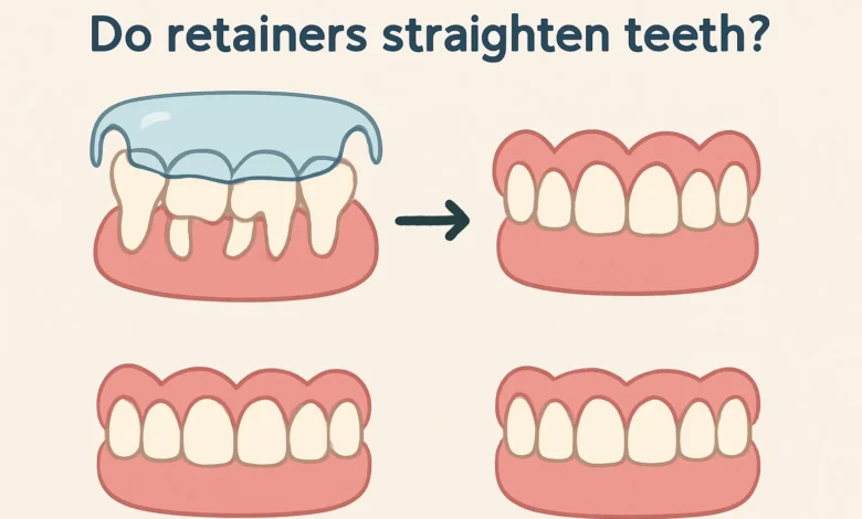 Explore how retainers work to straighten teeth and their role in maintaining orthodontic results.