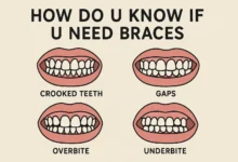 How Do U Know If U Need Braces explained with clear signs and expert guidance