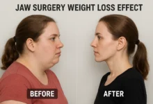 Jaw surgery weight loss effect: How jaw surgery can influence weight and metabolism.