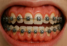 Puffy Gums With Braces explained with causes, treatment options, and prevention tips