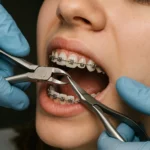 Taking Off Braces is an exciting process that reveals a straighter, healthier, and more confident smile