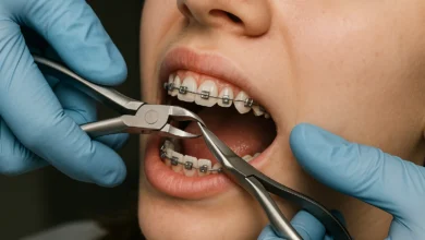Taking Off Braces is an exciting process that reveals a straighter, healthier, and more confident smile