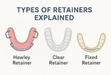 Types of Retainers Explained with clear details on fixed and removable options for orthodontic patients.