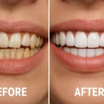 Veneers Before After Crooked Teeth – Transforming crooked teeth with veneers, showing the difference before and after treatment for a straight smile.