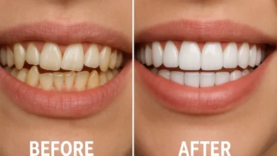Veneers Before After Crooked Teeth – Transforming crooked teeth with veneers, showing the difference before and after treatment for a straight smile.