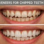 Veneers for Chipped Teeth – How veneers can restore the appearance of chipped teeth and provide a natural, smooth finish.