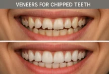 Veneers for Chipped Teeth – How veneers can restore the appearance of chipped teeth and provide a natural, smooth finish.