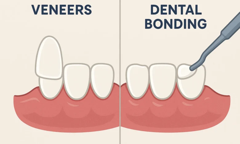 Veneers vs dental bonding, comparing cosmetic dental treatments for enhancing smile appearance