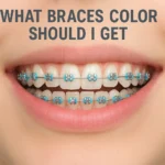 What Braces Color Should I Get is the most common question teens and adults ask when choosing the perfect shade for their smile