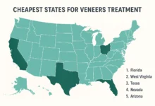 Affordable veneers treatment options in the cheapest states in the USA