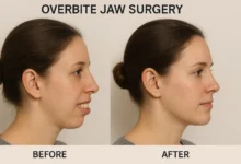 Overbite jaw surgery before after showing dramatic transformation in bite alignment and facial aesthetics.