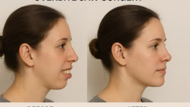 Overbite jaw surgery before after showing dramatic transformation in bite alignment and facial aesthetics.